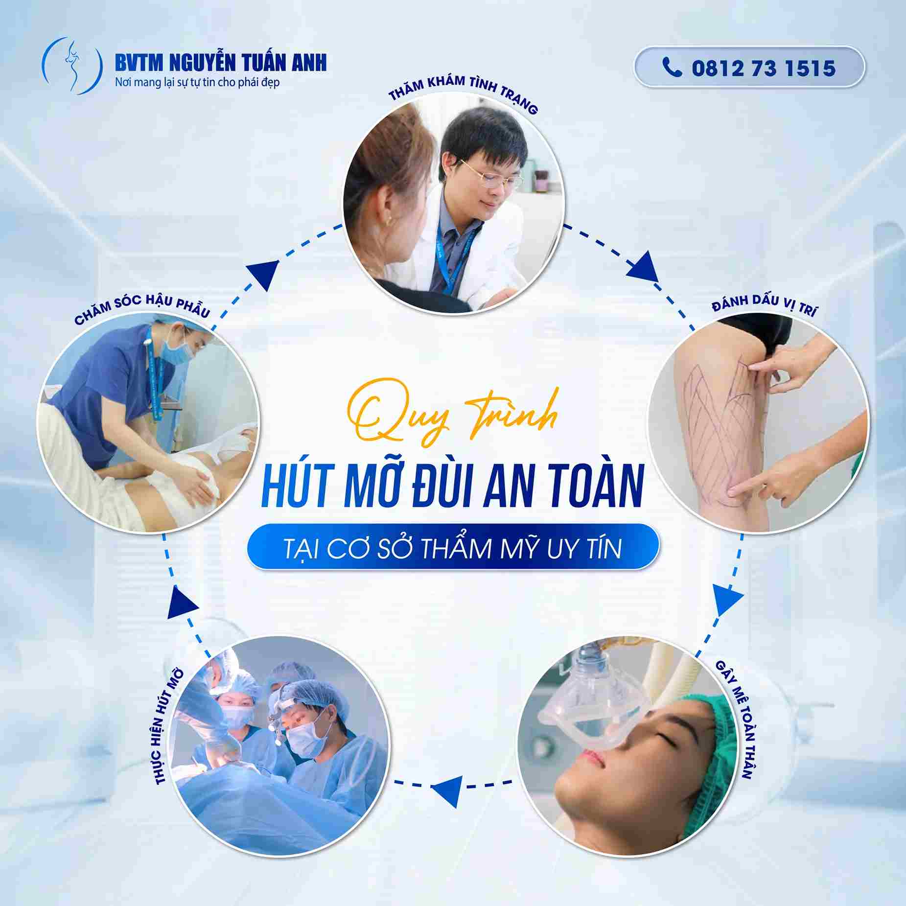 Quy trình hút mỡ đùi an toàn tại cơ sở thẩm mỹ uy tín